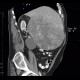 Hepatocellular carcinoma, HCC: CT - Computed tomography