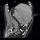 Hepatocellular carcinoma, HCC: CT - Computed tomography