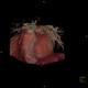 CT angiography of heart: CT - Computed tomography