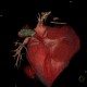 CT angiography of heart: CT - Computed tomography