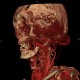 Hemangioma of face, extensive: CT - Computed tomography