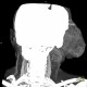 Hemangioma of face, extensive: CT - Computed tomography