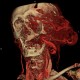 Hemangioma of face, extensive: CT - Computed tomography