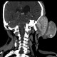 Hemangioma of face, extensive: CT - Computed tomography