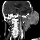 Hemangioma of face, extensive: CT - Computed tomography