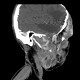 Hemangioma of face, extensive: CT - Computed tomography