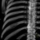 Hemangioma of rib: CT - Computed tomography