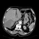 Hematoma of liver, subcapsular hematoma: CT - Computed tomography