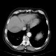 Hematoma of liver, subcapsular hematoma: CT - Computed tomography