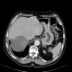 Hematoma of liver, subcapsular hematoma: CT - Computed tomography