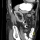 Hematoma after renal biopsy: CT - Computed tomography