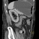 Hematoma after renal biopsy: CT - Computed tomography