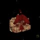 Hemocephalus, ventricular bleeding: CT - Computed tomography