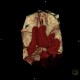 Hemocephalus, ventricular bleeding: CT - Computed tomography