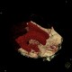 Hemocephalus, ventricular bleeding: CT - Computed tomography