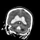 Hemocephalus, ventricular bleeding: CT - Computed tomography