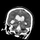 Hemocephalus, ventricular bleeding: CT - Computed tomography
