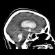 Hemocephalus, ventricular bleeding: CT - Computed tomography