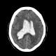 Hemocephalus, ventricular bleeding: CT - Computed tomography
