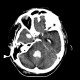 Hemocephalus, ventricular bleeding: CT - Computed tomography