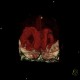 Hemocephalus, ventricular bleeding: CT - Computed tomography