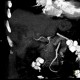 Liver tumour, 3-phase CT: CT - Computed tomography
