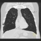 Lung hernia, centrilobular emphysema: CT - Computed tomography