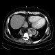 Hiatal hernia, mixed type, reactive fluid: CT - Computed tomography