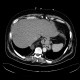 Hiatal hernia, mixed type, reactive fluid: CT - Computed tomography