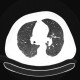 Hypersensitivity pneumonitis, subacute: CT - Computed tomography