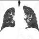 Hypersensitivity pneumonitis, subacute: CT - Computed tomography