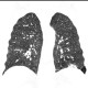 Hypersensitivity pneumonitis, subacute: CT - Computed tomography