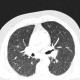 Hypersensitivity pneumonitis, subacute: CT - Computed tomography