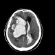 Brain hemorrhage, hypertonic, hemocephalus: CT - Computed tomography