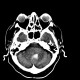 Brain hemorrhage, hypertonic, hemocephalus: CT - Computed tomography