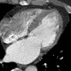 Hypodense subendocardial layer, myocardial infarction: CT - Computed tomography