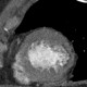 Hypodense subendocardial layer, myocardial infarction: CT - Computed tomography