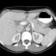 Focal hepatopathy, falciform ligament: CT - Computed tomography