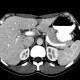 Focal hepatopathy, falciform ligament: CT - Computed tomography