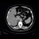 Hemangioma, CEUS: CT - Computed tomography