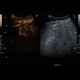 Hemangioma, CEUS: US - Ultrasound