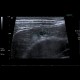 Hemangioma of liver, cavernous hemangioma, capillary hemangioma: US - Ultrasound