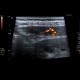 Hemangioma of liver, cavernous hemangioma, capillary hemangioma: US - Ultrasound