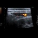 Hemangioma of liver, cavernous hemangioma, capillary hemangioma: US - Ultrasound
