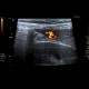 Hemangioma of liver, cavernous hemangioma, capillary hemangioma: US - Ultrasound