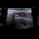Hemangioma of liver, cavernous hemangioma, capillary hemangioma: US - Ultrasound