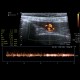 Hemangioma of liver, cavernous hemangioma, capillary hemangioma: US - Ultrasound