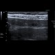 Hemangioma of liver, cavernous hemangioma, capillary hemangioma: US - Ultrasound