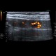 Hemangioma of liver, cavernous hemangioma, capillary hemangioma: US - Ultrasound