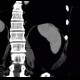 Hemangioma of spleen, splenic hemangioma: CT - Computed tomography